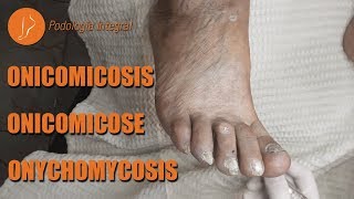 Fungus  Onychomycosis podology asmr [upl. by Rednasxela804]