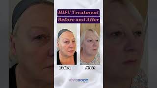 HIFU BEFORE AND AFTER TREATMENT skincare hifu hifufacelifting hifufacelift [upl. by Jamal687]