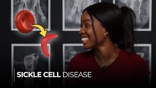 Sickle Cell Disease Understanding the Causes Symptoms and Sickle Cell Crisis [upl. by Evadne]