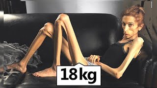 This Is the Thinnest Person In The World [upl. by Aenel]