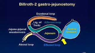 01 Billroth 2 reconstruction animation [upl. by Thurstan203]