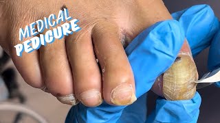 HOW TO GET BUTTERY SOFT FEET MEDICAL PEDICURE [upl. by Meridel]