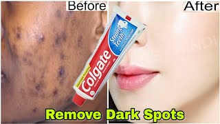 चेहरे के दाग धब्बे और निशान हटाकर चेहरा एकदम साफ कर देगा । Remove Dark spots from Face [upl. by Marden]