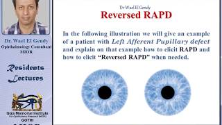 Reversed RAPD explained [upl. by Solley]