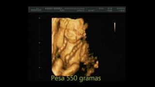 MEDIPEDIA Feto com 5 meses 3D4D em tempo real Ultrassonografia [upl. by Zerimar]