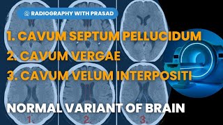 Cavum Septum Pellucidum Callosum Vergae and Cavum Velum Interpositi in details prasadlayek [upl. by Ahsirek]