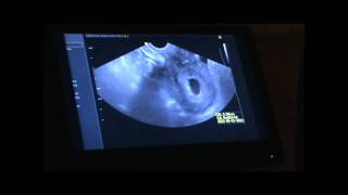 6 Week Ultrasound  HEARTBEAT [upl. by Jarrow]