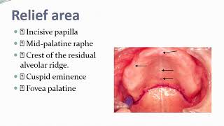 Prosthodontics 401 Anatomical landmarks of edentulous mouth [upl. by Jarrell]