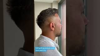 Saç ekiminden sonra donör alanı  Donor area after hair transplant [upl. by Kissee595]