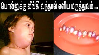 பொன்னுக்கு வீங்கி வந்தால் எளிய மருத்துவம்  Home Remedi For Mumps [upl. by Cirdor]