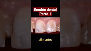 ¿Que es la erosión dental shorts [upl. by Cutlerr386]