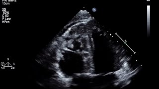 Arrhythmogenic Right Ventricular DysplasiaCardiomyopathy [upl. by Ettena]