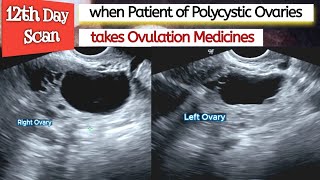 Ovarian CYSTS  Ovulation Medicines in PCOS Patient  Polycystic Ovaries  Infertility [upl. by Anairdna]