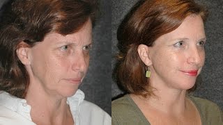 Mini Facelift Before and After on 51 Year Old Woman  Dr Andrew Jacono Reviews minifacelift [upl. by Fiel]