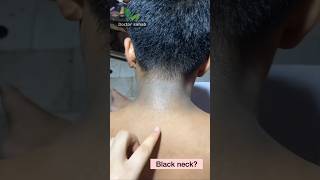 Black Neck Remedies  The Casual Style youtubeshorts blackneck neck [upl. by Mara]