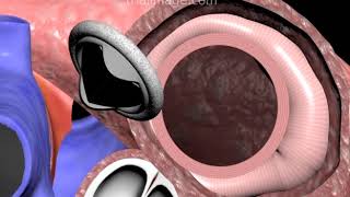 Mitral Valve Replacement Procedure Animation by Cal Shipley MD [upl. by Arakat]