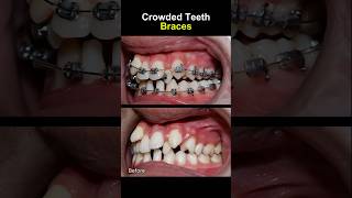 Teeth very crowded and crooked before braces orthodontist braces dentist [upl. by Luiza]