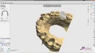 Screw Retained Anatomical Crown 26 Abutment Design Part 1 [upl. by Aierb641]