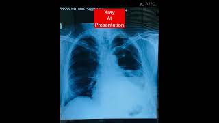 Pyothorax फेफड़े मे पस lungsproblem diseaseawareness viralshorts pleuraleffusion viral tb [upl. by Aronael]