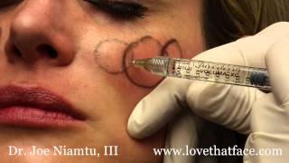 Juverderm Voluma 5 Minute Cheeks by Dr Joe Niamtu III [upl. by Segroeg]