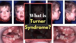 Turner syndrome Symptoms  Causes Pictures Signs and Symptoms of Turners syndrome [upl. by Analat730]