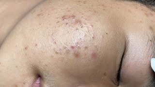 ACNE TREATMENT VU QUYNH MI  Blackheads On Boy Face 2024FULL [upl. by Ayot]