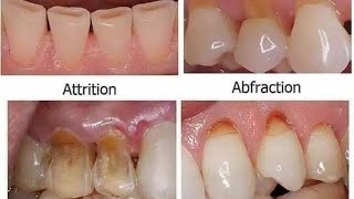 NON CARIOUS LESION  ATTRITION ABRASION EROSION [upl. by Evslin]