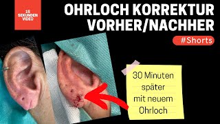 Ohrlochkorrektur Verschluss eines ausgerissenen Ohrläppchens Und gleich ein neues Ohrloch Shorts [upl. by Alebasi]