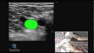 How To Deep Vein Thrombosis Ultrasound Exam 3D Video [upl. by Gravante]