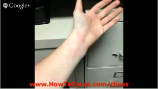 Allergic Urticaria  Treatments For Allieviating Acute Urticaria  Allergic Urticaria [upl. by Trish]