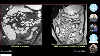 Colitis Ulcerosa Evaluacion Ecografica [upl. by Etnud]