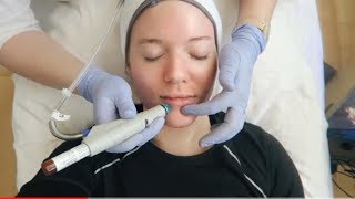 HYDRAFACIAL TREATMENT Before amp After [upl. by Eceinej]