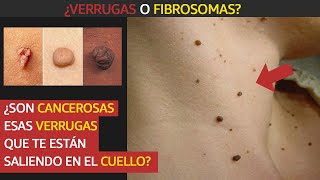 ¿Son cancerosas esas verrugas que te están saliendo en el cuello [upl. by Eimar]