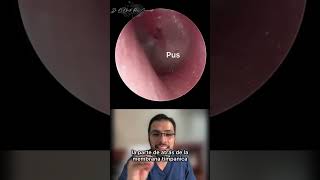 Infección de oído Otitis Media Aguda  Dr Obeth Ríos [upl. by Africa]