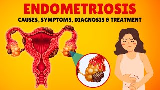 What is Endometriosis Causes Signs and Symptoms Diagnosis amp Treatment [upl. by Raama]