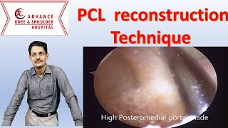 PCL reconstruction surgical steps [upl. by Skipper305]