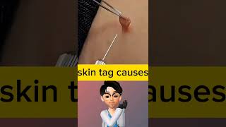 Doctor explains skin tags causes amp treatment idoctor [upl. by Sedecram]