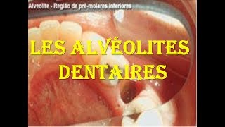 Les alvéolites dentaires [upl. by Ariew]