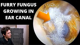 Mystery Furry Fungus Growing in Ear [upl. by Long]