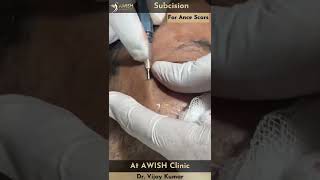 Subcision Treatment for Acne scars by Dr Vijay Kumar at AWISH CLINIC acnescars subcision shorts [upl. by Dirrej388]