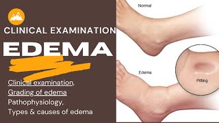 Edema Clinical examination Grading Pathophysiology amp Types of edemaMedical studentsMedicine [upl. by Ffirahs]