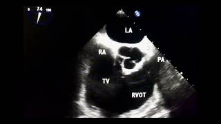 Arrhythmogenic right ventricular dysplasia in echo  to drahmadmirdamadisiX8VVEalnfG0xrD7 [upl. by Hillary]