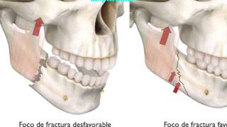 Fracturas Mandibulares [upl. by Deckert892]