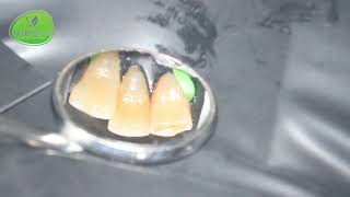 Teeth 23 24 25  Painless Root Canal at quotEvergreen Endodonticsquot in Issaquah by Dr Nima [upl. by Supple]