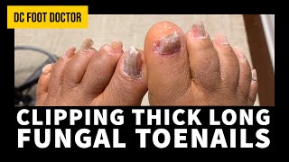 Clipping Thick Long Fungal Toenails [upl. by Nwahshar]