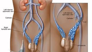 Live Varicocele Embolisation Treament by Dr Shailesh Kumar Garge [upl. by Boehike]