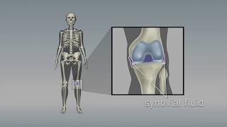 Osteoarthritis of the knee Choosing the right pain medicine [upl. by Nnahsal]