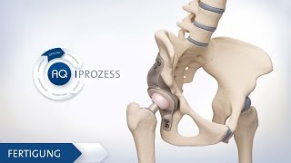 Hüft TEP  Individuelles künstliches Hüftgelenk Ärztefassung deutsch  3D Animation Medizin [upl. by Aikan635]