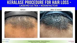 KeraLase Procedure For Hair Loss  LaseMD ULTRA  KeraFactor [upl. by Ahseital]