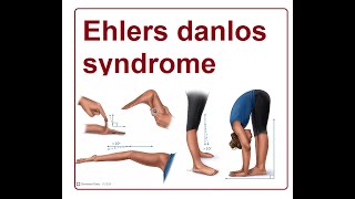 Ehlers Danlos Syndrome  2024 [upl. by Saixela]